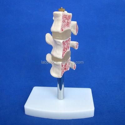 Προχωρημένα εκπαιδευτικά μοντέλα PVC Cutaway Οστεοπόρωση της σπονδυλικής στήλης